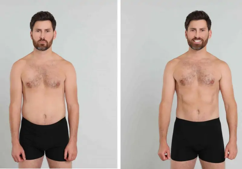 Abdominoplastia masculina: valores, indicações e resultados