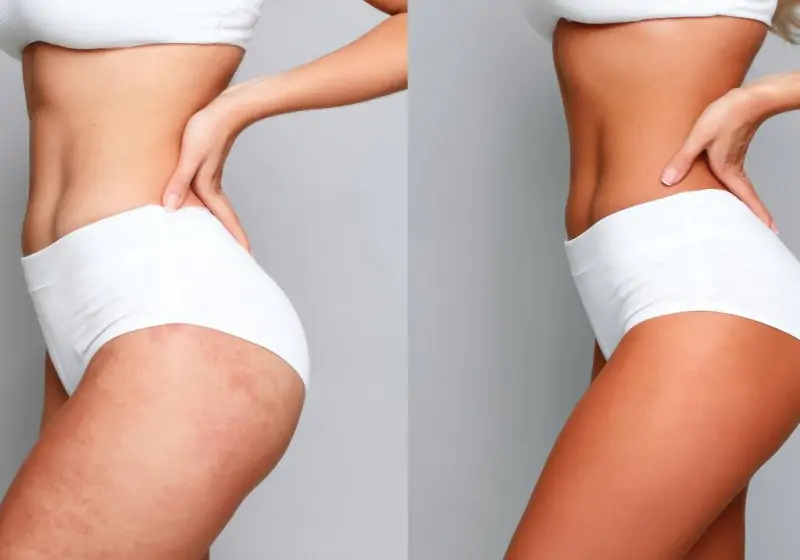 Flacidez nas coxas: causas e tratamentos mais eficazes