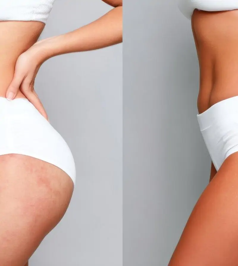Flacidez nas coxas: causas e tratamentos mais eficazes