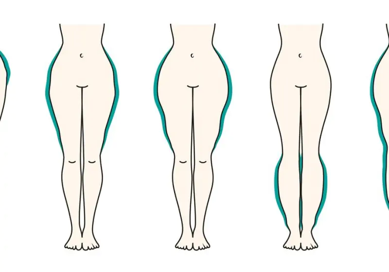 Gordura de lipedema: diferenças da obesidade e formas de tratamento