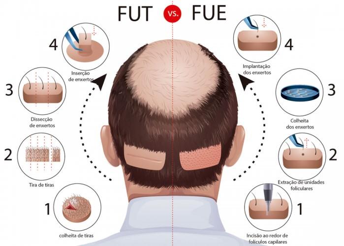 Técnica FUE de transplante capilar: O que é e vantagens [Guia] - Clínica  Ser Cirurgia Plástica