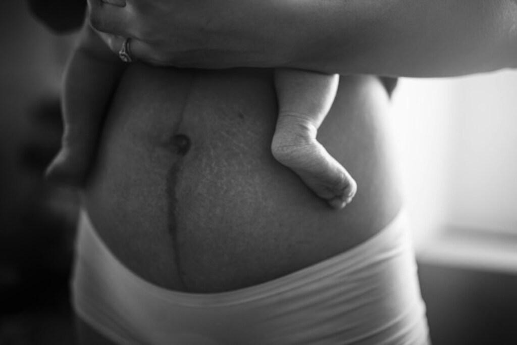 Cirurgia plástica na barriga: conheça os principais procedimentos