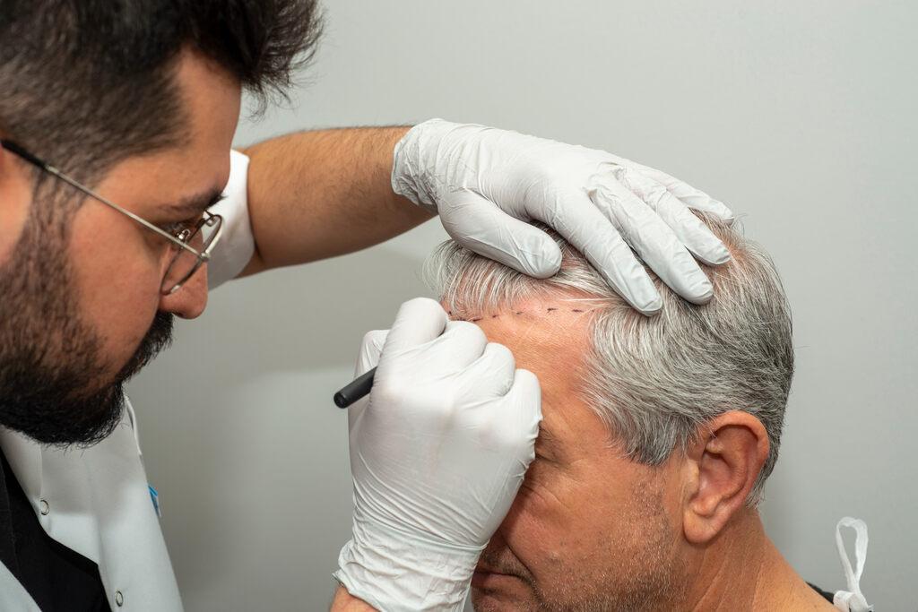 Tipos de Transplante Capilar: conheça as principais técnicas