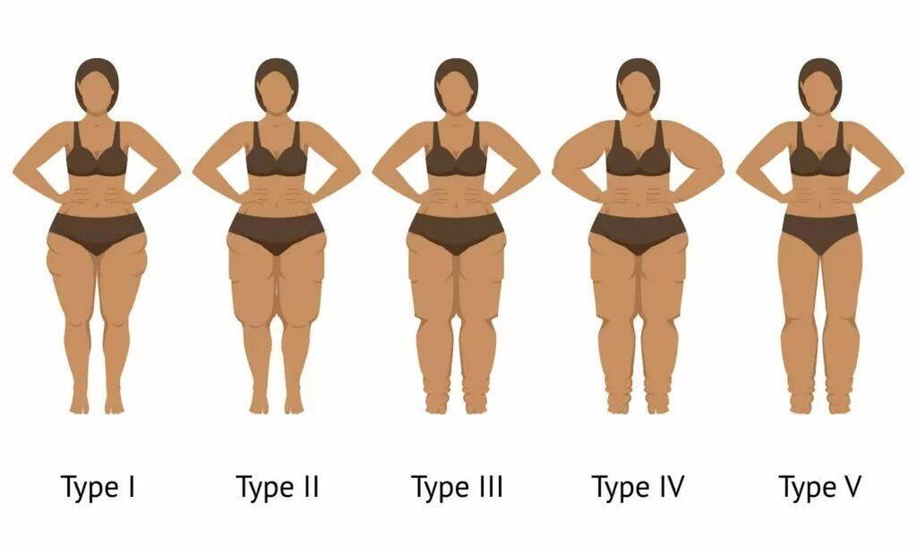 Como saber se é lipedema ou celulite? Confira com a Clínica SER! Como saber se é lipedema ou celulite? Confira com a Clínica SER!