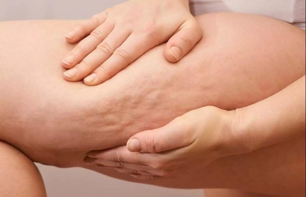 Como saber se é lipedema ou celulite? Confira com a Clínica SER! Como saber se é lipedema ou celulite? Confira com a Clínica SER!