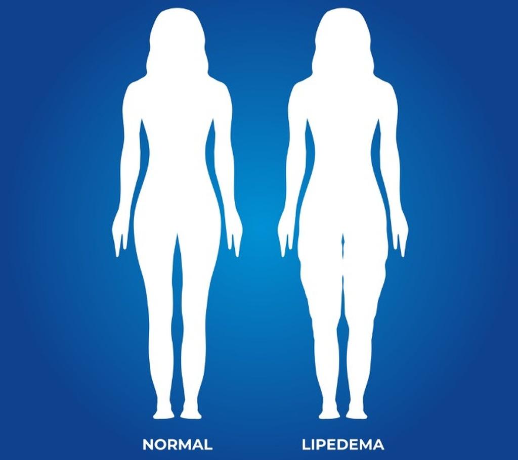 Lipedema em pessoas magras é possível? Confira!