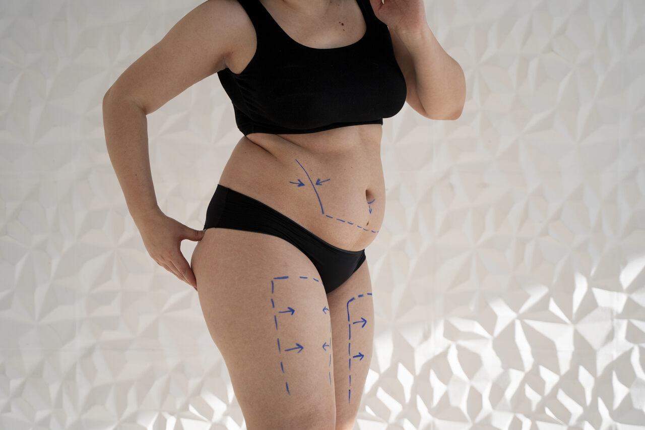 Barriga em avental: causas e tratamentos para o abdome Barriga em avental: causas e tratamentos para o abdome