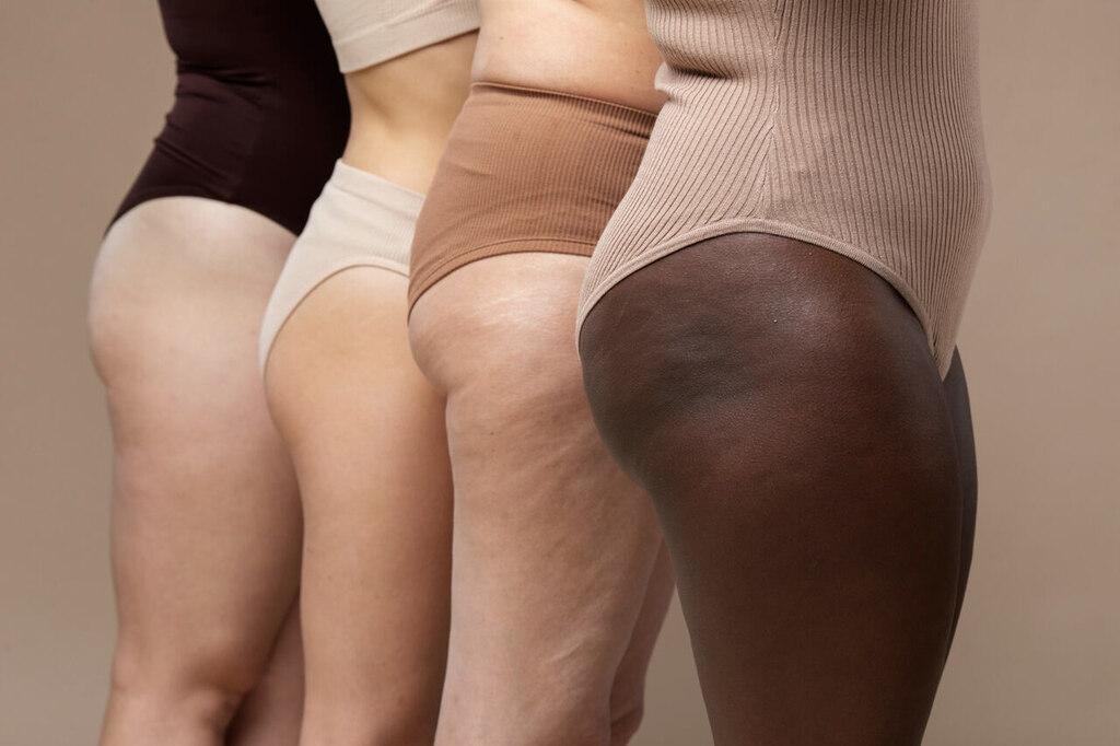 Como diagnosticar lipedema? Sintomas e exames necessários para identificar o problema