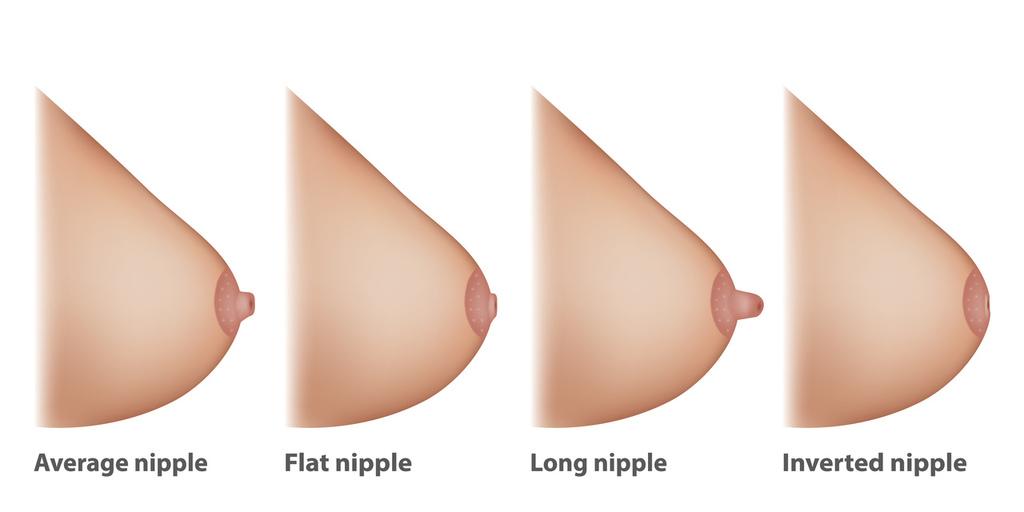 Mamilo invertido: entenda as causas e soluções possíveis