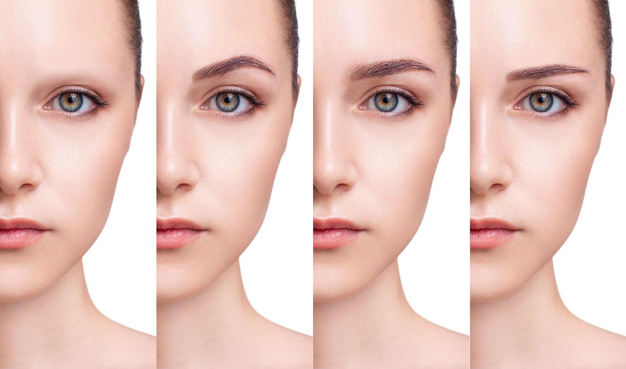 Transplante de sobrancelhas: técnica, recuperação e resultados