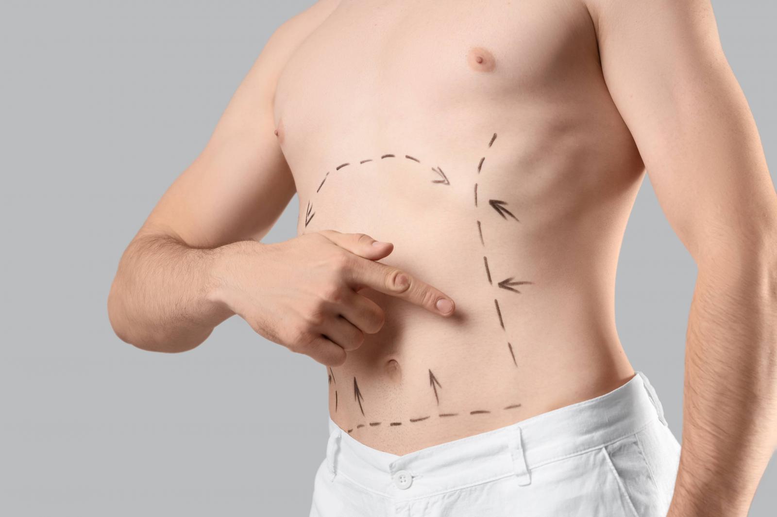 Abdominoplastia masculina: valores, indicações e resultados