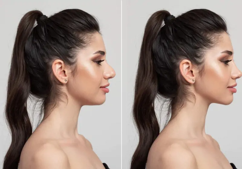 Perfiloplastia: o que é e como o procedimento harmoniza o rosto