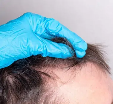 Você sempre quis saber se é possível passar por um transplante capilar sem raspar o cabelo? Veja a resposta e qual é a melhor técnica cirúrgica!